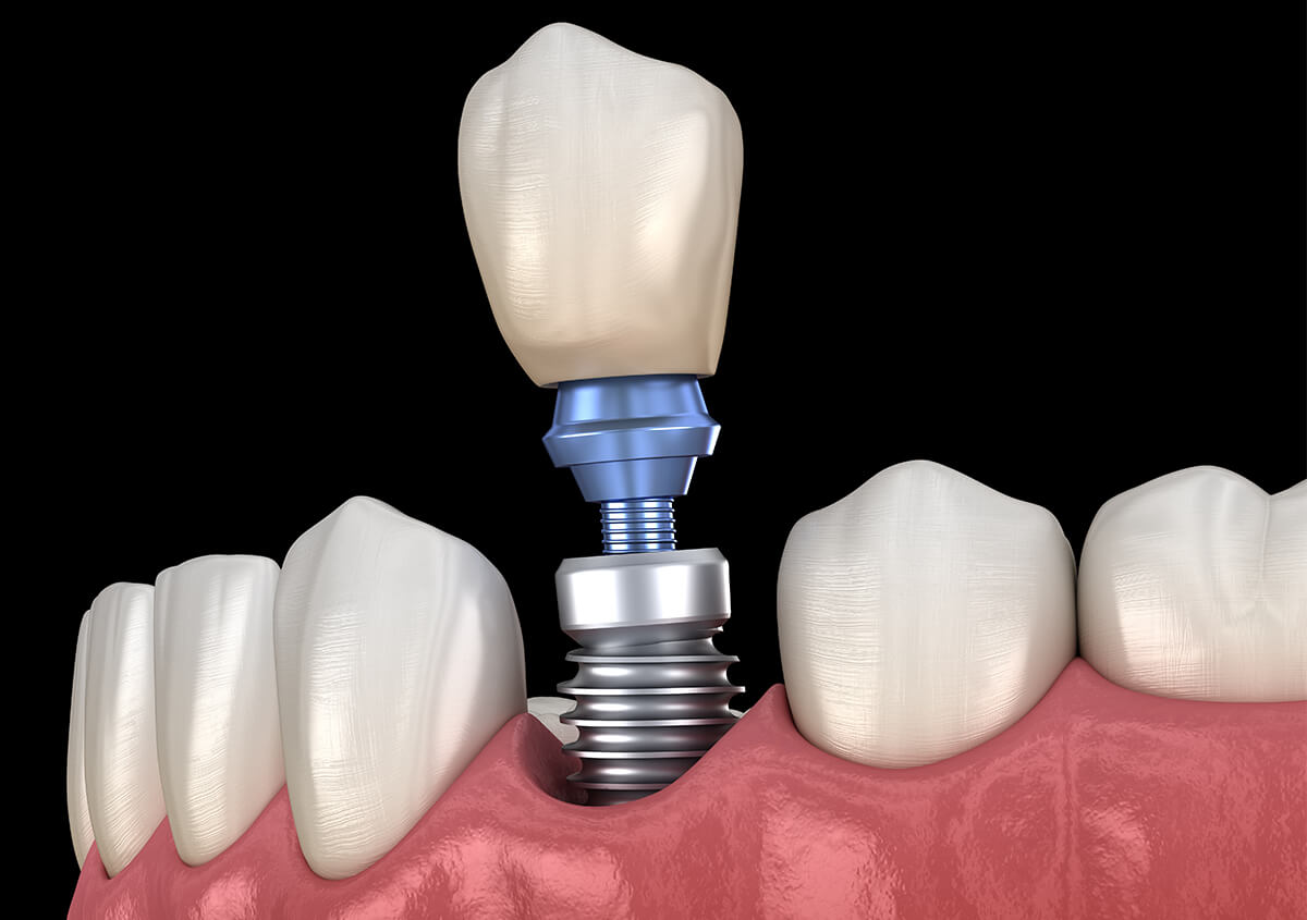 Dental Implant Services in Manteca CA Area