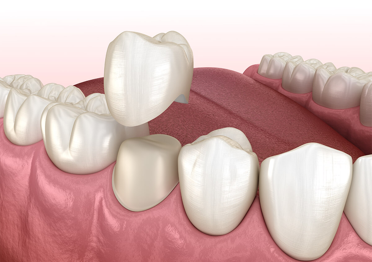 How To Care For Your Dental Crown in Manteca CA Area