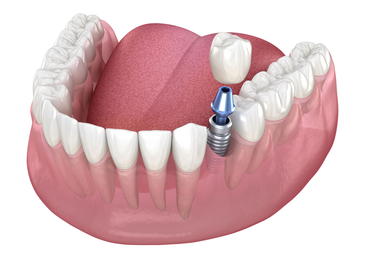 A Look into What Can Happen When You Do Not Replace a Missing Tooth With A Dental Implant or Other Tooth Replacement Option