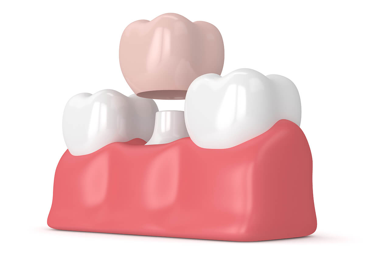 Dental Crown for Broken Tooth in Manteca CA Area