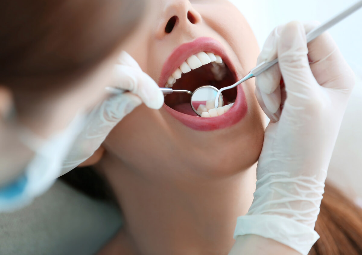 Dental Bonding for Chipped Teeth in Manteca CA area