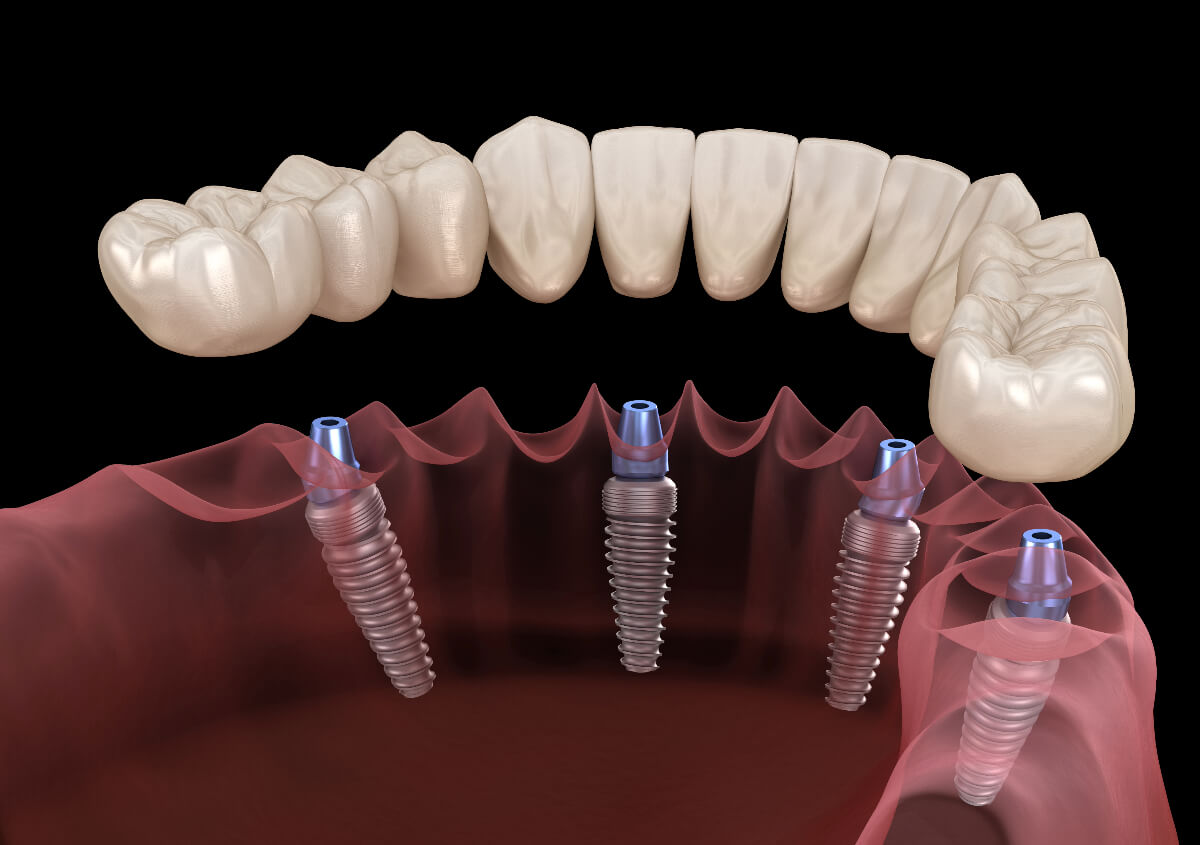 Full Arch Dental Implants in Manteca CA area