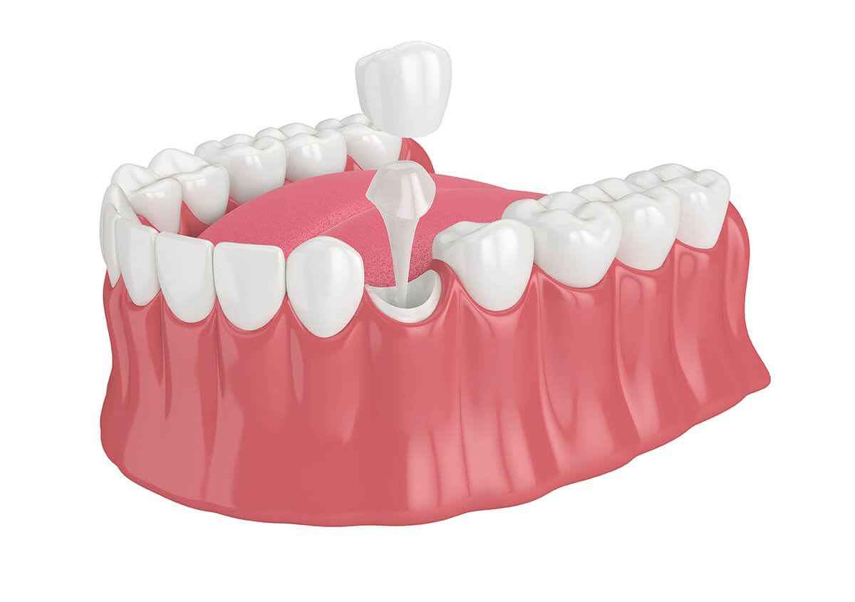 Affordable Dental Crowns Near Me Manteca CA Area